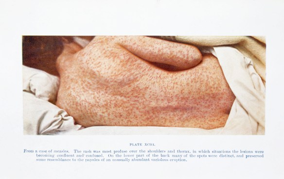 L0032962 Back of female with measles